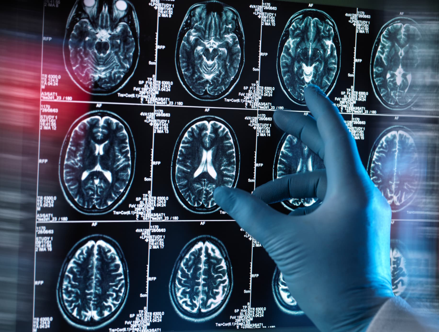 Dementia consultation or brain imaging scan